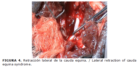 FIGURA 4. Retracci&oacute;n lateral de la cauda equina. / Lateral retraction of cauda equina syndrome.