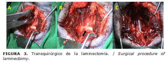 FIGURA 3. Transquir&uacute;rgico de la laminectom&iacute;a. / Surgical procedure of laminectomy.